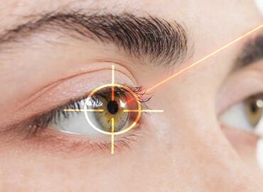 lazer-ile-goz-ameliyati-nedir-3216